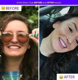 Smile Direct Club Before & After Photos, Results, Transforma