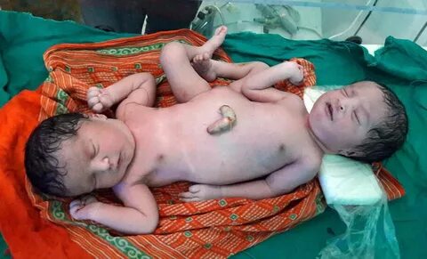 The Sun в Твиттере: "Indian mother gives birth to conjoined 