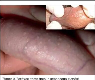 Figure 2 from Penile appearance, lumps and bumps. Semantic S