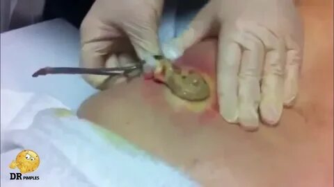 Mega PIMPLE Popping Close this if you are Cowardly - YouTube