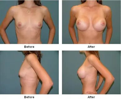 Breast Augmentation Before and After at Estetica Institute o