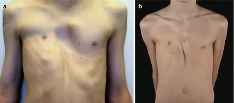 Success And Duration Of Dynamic Bracing For Pectus Carinatum