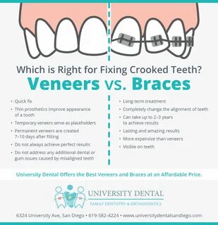 Veneers vs Braces: Which Is Right for Fixing Crooked Teeth? 