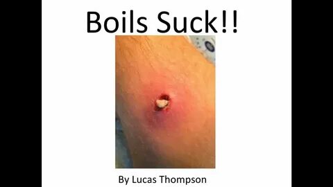 Staph infection boils suck, learn the treatment for boils th