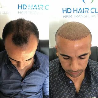 HD Hair Clinic adlı kullanıcının Saç Ekimi panosundaki Pin S