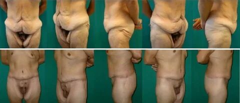 The experience performing extended abdominoplasty in massive