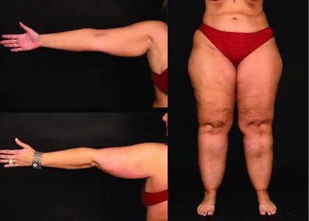 Lipoedema of whole leg and upper arm type. Download Scientif