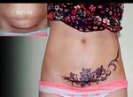 Tattoos To Cover Up Tummy Tuck Scars - Best Images Hight Qua