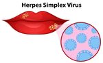 Diagram showing herpes simplex virus 418753 Vector Art at Ve