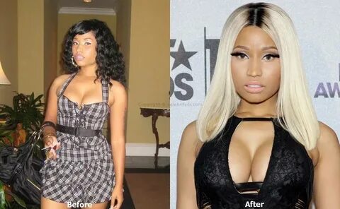 Nicki Minaj Plastic Surgery Before and After - Celebrity Dr.