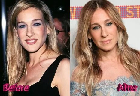 Sarah Jessica Parker Before and After Surgery Procedure Beau