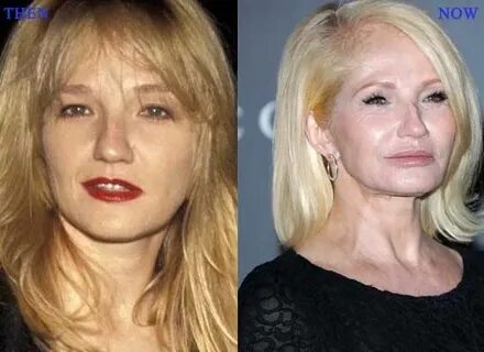 Ellen Barkin Plastic Surgery