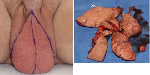 Plastic Surgery Case Study - Scrotal Reduction for Chronic E