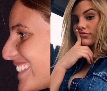 Lele Pons Before and After Rhinoplasty Performed By Dr. Kass