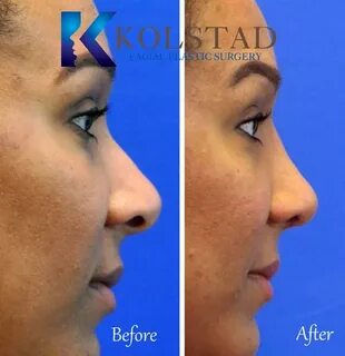 Rhinoplasty Before & After Gallery Dr. Kolstad - San Diego F