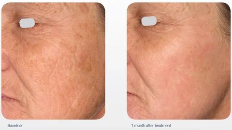 Lincoln Aesthetics and Cosmetic Med Spa Acupulse Skin Resurf