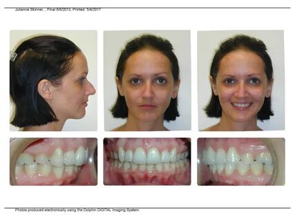 Before and After Gallery Invisalign Center of Long Beach