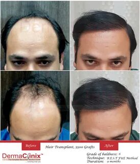 Hair Transplant Surgery & PRP Results, Before and After Phot