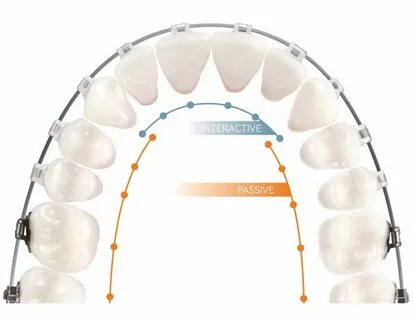 Self Ligating Brackets American Orthodontics