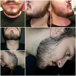 How To Grow Patchy Beard Reddit : How Long Does It Take To G