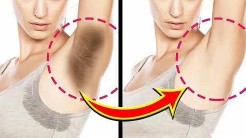 6 Natural and Effective Ways to Deal With Dark Underarms by 