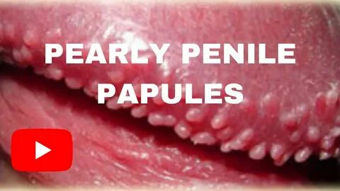 PEARLY PENILE PAPULES- Men's Problem - YouTube