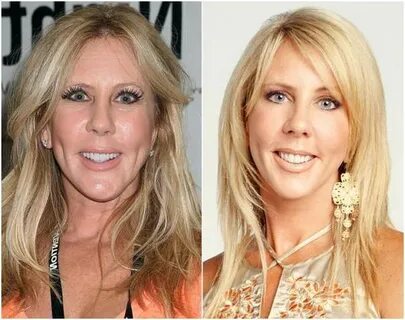 Vicki Gunvalson Plastic Surgery Before & After Chin implant,