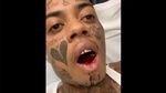 Damn: Boonk Gang Got His Jaw Broken On Both Sides After Gett