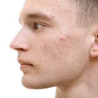 Acne (Pimples) - Causes, Types, Best Treatments - BAOSPACE