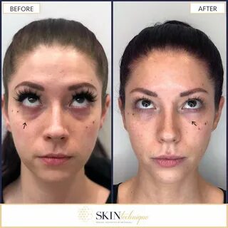 Under Eye Hollow Filler Before And After - change comin