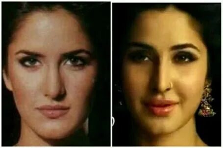 Katrina Kaif Plastic Surgery