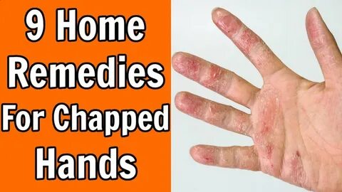 9 Home Remedies For Chapped Hands - YouTube