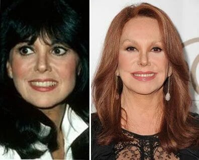 Marlo Thomas Plastic Surgery Before and After Photo 2013-201