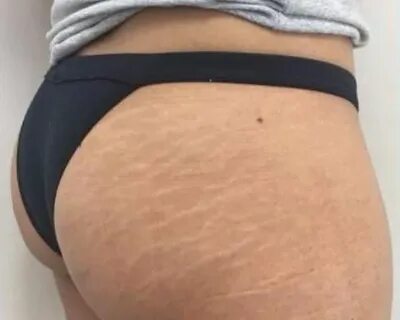 Instagram is OBSESSED with tat artist who hides STRETCH MARK