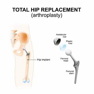 Focus On: Hip Replacement Surgery Aqua Physio