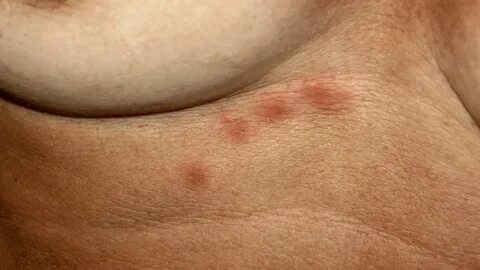 Small itchy rash on back chest and under boobs