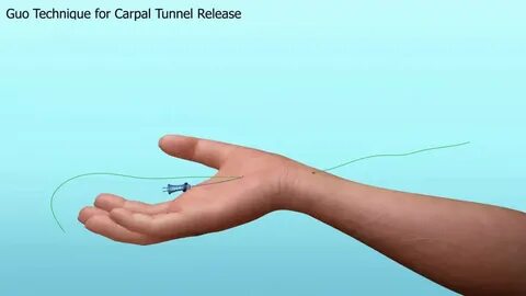 File:GuoTech for Thread Carpal Tunnel Release.webm - Wikiped