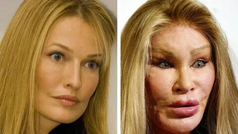 Worst Cases Of Plastic Surgery Obsession Celebrity plastic s