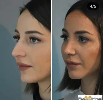 Non Surgical Nose Job For Wide Nose Uk 2022 at en - news.pap