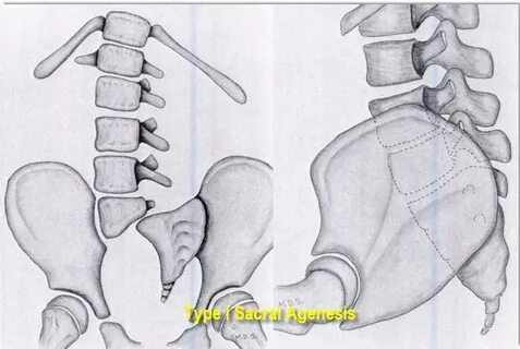 Sacral Agenesis - Pediatrics - Orthobullets