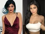 Kylie Jenner Before and After Transformation - Plastic Surge