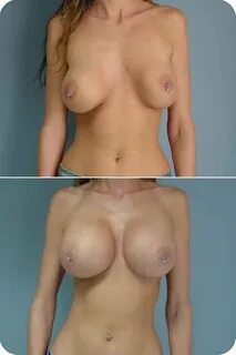 Hot Nude Implanted Boobs - Porn Photos Sex Videos