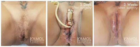 MTF Surgery Correction - Kamol Cosmetic Hospital
