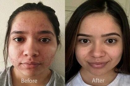 Proactiv Before and After Stories + Pictures and Video