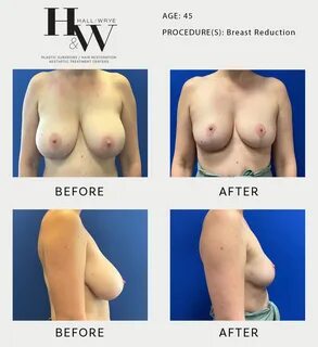 Breast Reduction - Hall & Wrye - Plastic Surgery and Medical Spa in Reno NV, Bre
