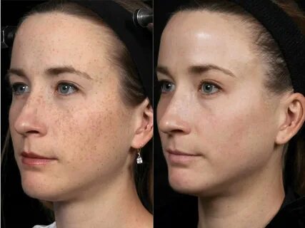 Laser Facial before and after Emerge Fractional Laser Result