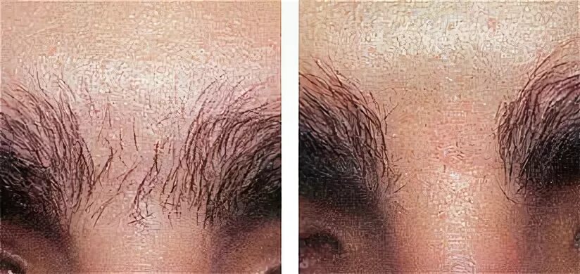 Ingrown Hair Brazilian Laser Hair Removal Before And After P