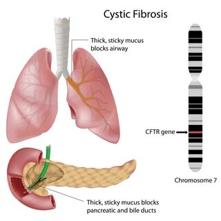 How Will We Be Treating Cystic Fibrosis 10 Years From Now? -
