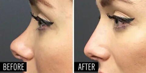 How a Plastic Surgeon Can Make This Nose Job Happen in 5 Min