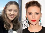 Scarlett Johansson, Before and After Hair implants, Celebrit